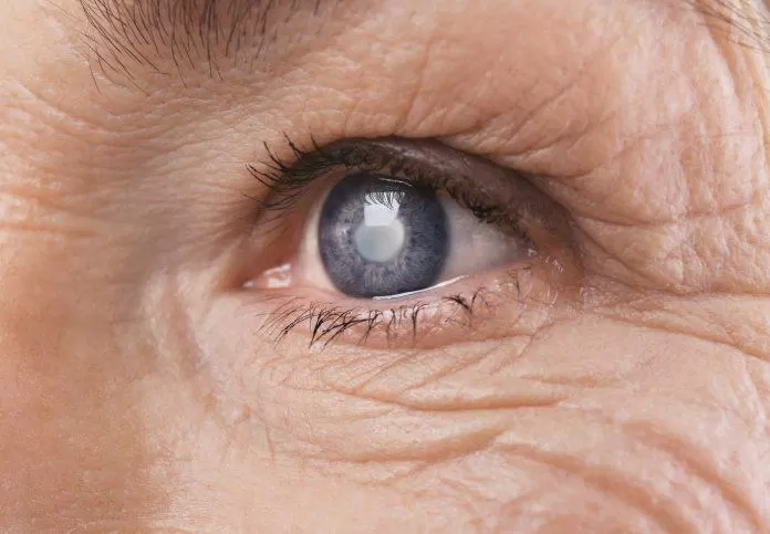 Đục thủy tinh thể là một vấn đề về mắt do biến chứng của bệnh tiểu đường (Ảnh: Internet)