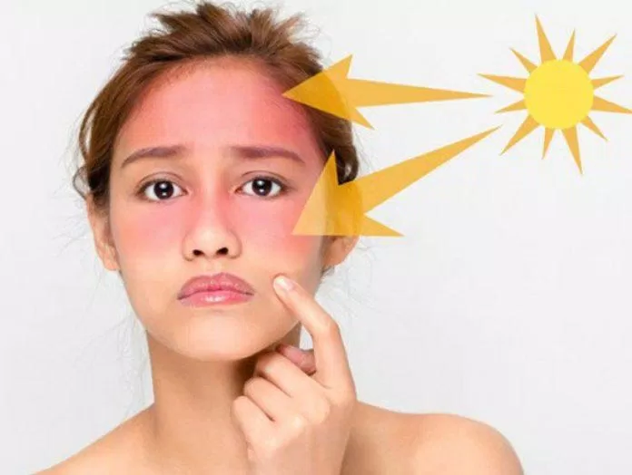 Tia UV là kẻ thù số một gây căng thẳng cho da (Ảnh: Internet)