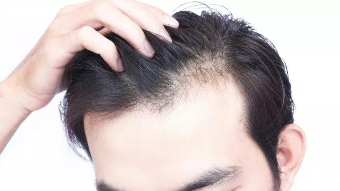 Rụng tóc cũng là một dấu hiệu của làn da căng thẳng (Ảnh: Internet)