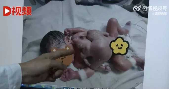 Em bé sơ sinh có 4 tay và 4 chân cực hiếm - Ảnh 2.